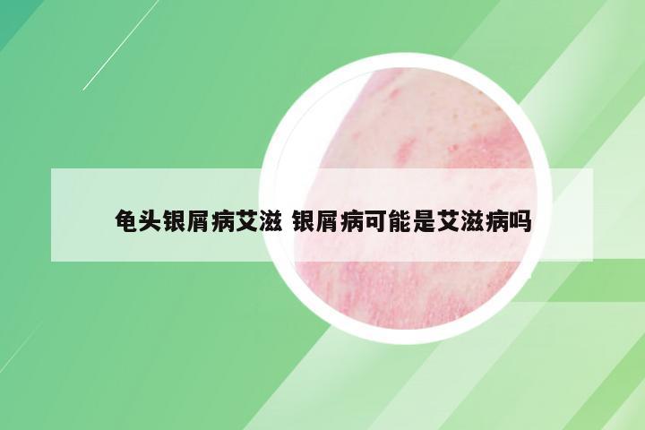 龟头银屑病艾滋 银屑病可能是艾滋病吗