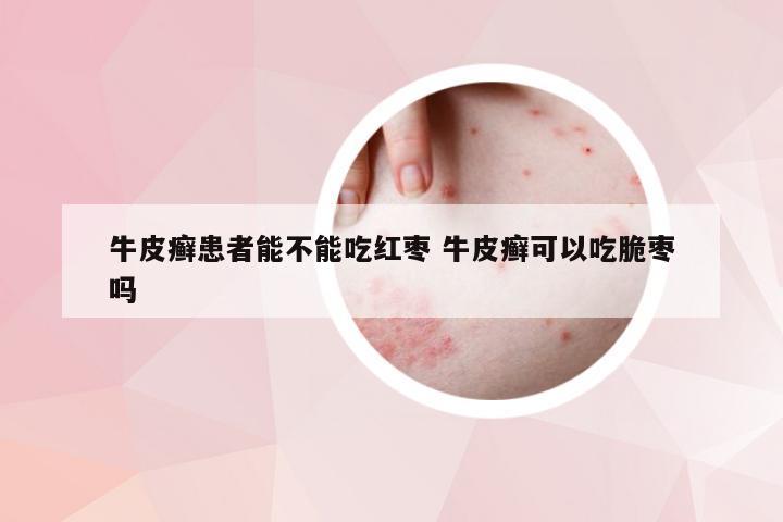 牛皮癣患者能不能吃红枣 牛皮癣可以吃脆枣吗