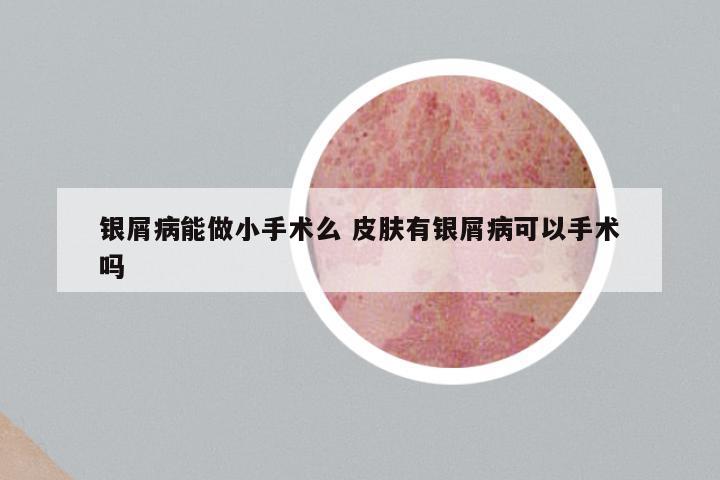 银屑病能做小手术么 皮肤有银屑病可以手术吗