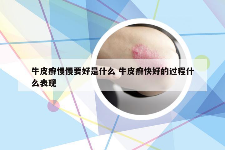 牛皮癣慢慢要好是什么 牛皮癣快好的过程什么表现