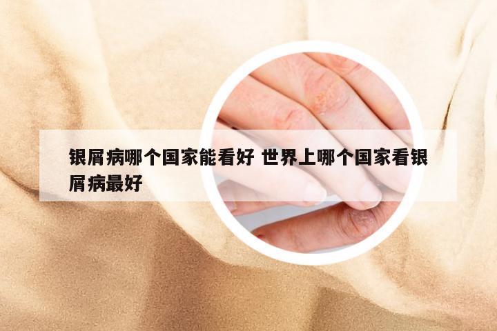 银屑病哪个国家能看好 世界上哪个国家看银屑病最好