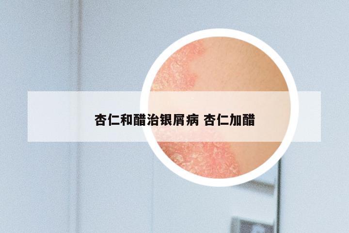 杏仁和醋治银屑病 杏仁加醋