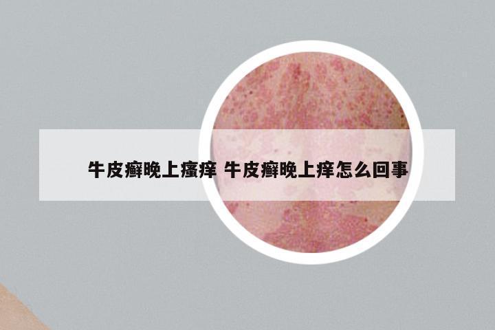 牛皮癣晚上瘙痒 牛皮癣晚上痒怎么回事