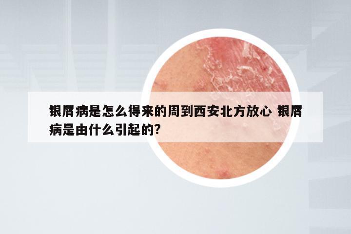 银屑病是怎么得来的周到西安北方放心 银屑病是由什么引起的?