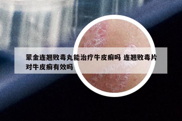 蒙金连翘败毒丸能治疗牛皮癣吗 连翘败毒片对牛皮癣有效吗