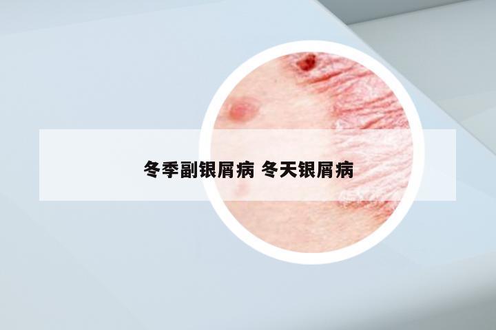 冬季副银屑病 冬天银屑病