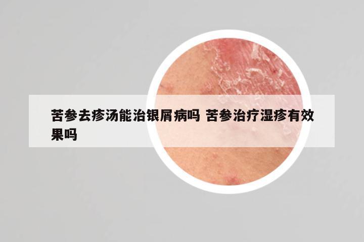 苦参去疹汤能治银屑病吗 苦参治疗湿疹有效果吗