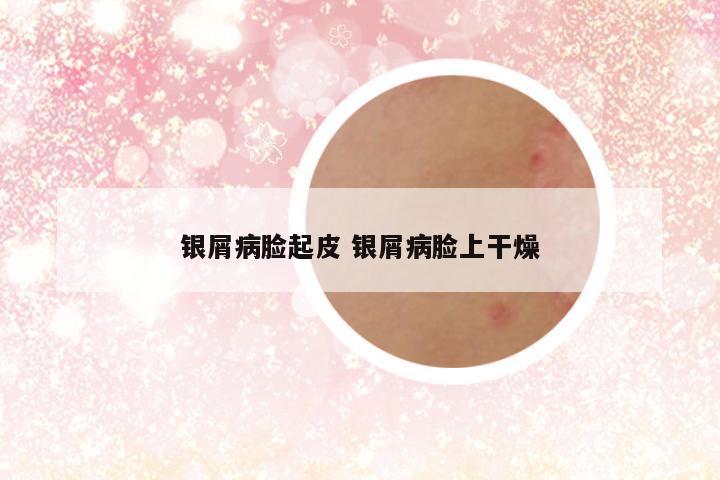 银屑病脸起皮 银屑病脸上干燥