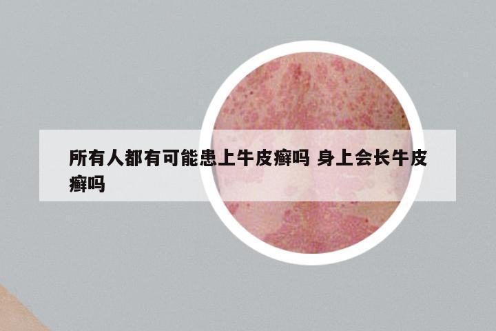 所有人都有可能患上牛皮癣吗 身上会长牛皮癣吗
