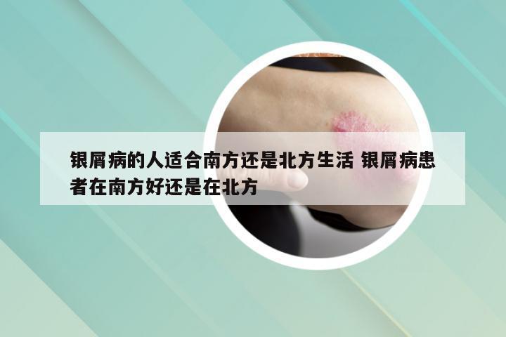 银屑病的人适合南方还是北方生活 银屑病患者在南方好还是在北方