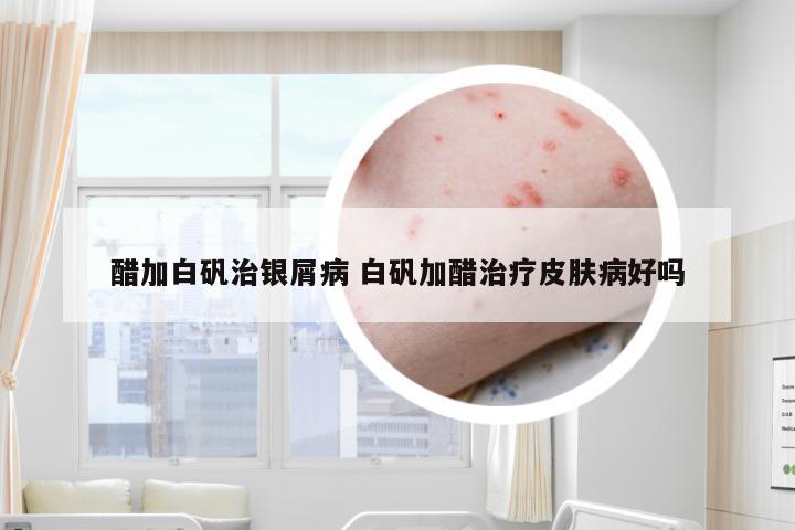 醋加白矾治银屑病 白矾加醋治疗皮肤病好吗