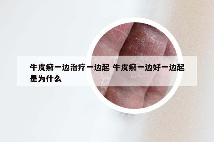 牛皮癣一边治疗一边起 牛皮癣一边好一边起是为什么
