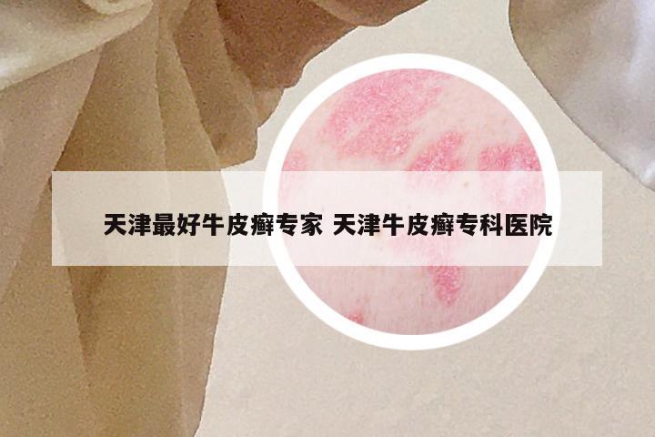 天津最好牛皮癣专家 天津牛皮癣专科医院