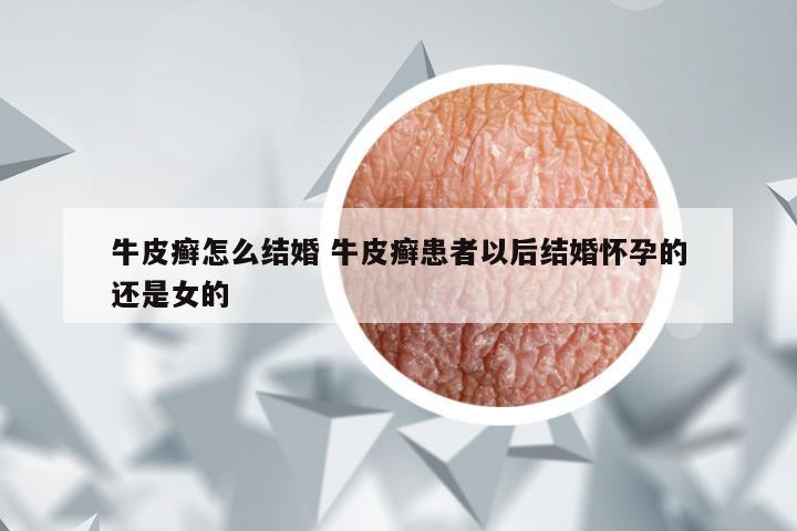 牛皮癣怎么结婚 牛皮癣患者以后结婚怀孕的还是女的