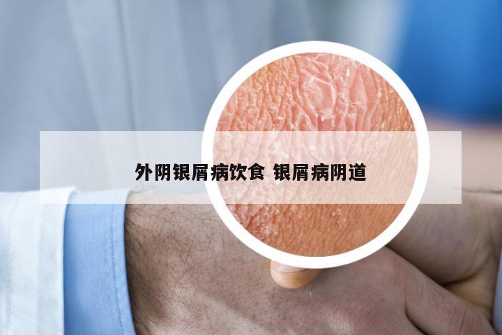 外阴银屑病饮食 银屑病阴道