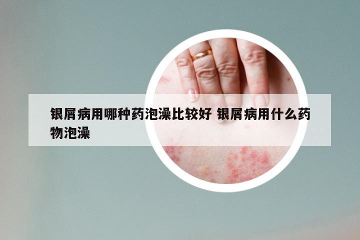 银屑病用哪种药泡澡比较好 银屑病用什么药物泡澡