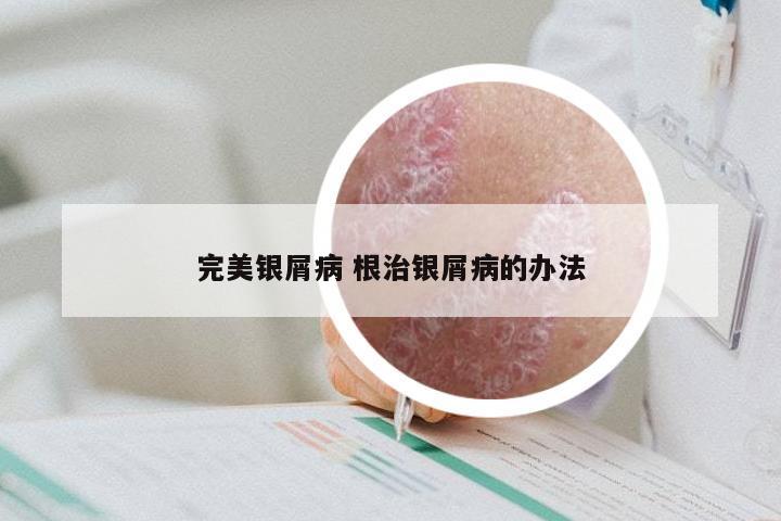 完美银屑病 根治银屑病的办法