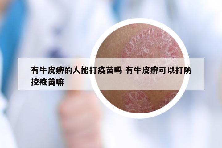 有牛皮癣的人能打疫苗吗 有牛皮癣可以打防控疫苗嘛