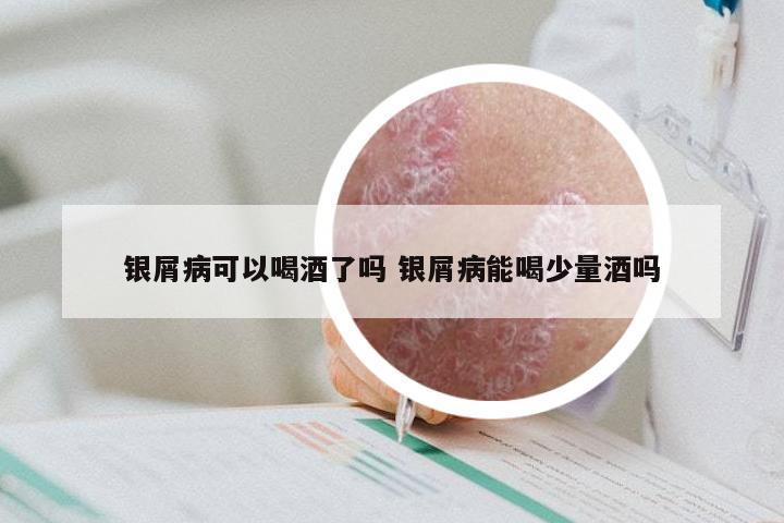 银屑病可以喝酒了吗 银屑病能喝少量酒吗