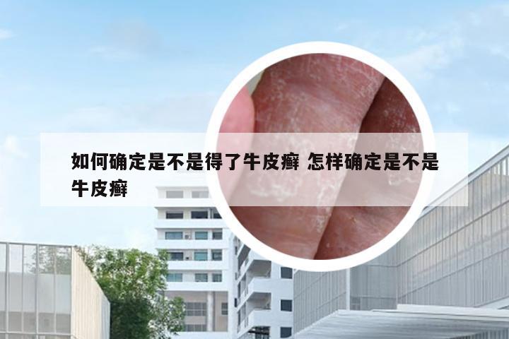 如何确定是不是得了牛皮癣 怎样确定是不是牛皮癣
