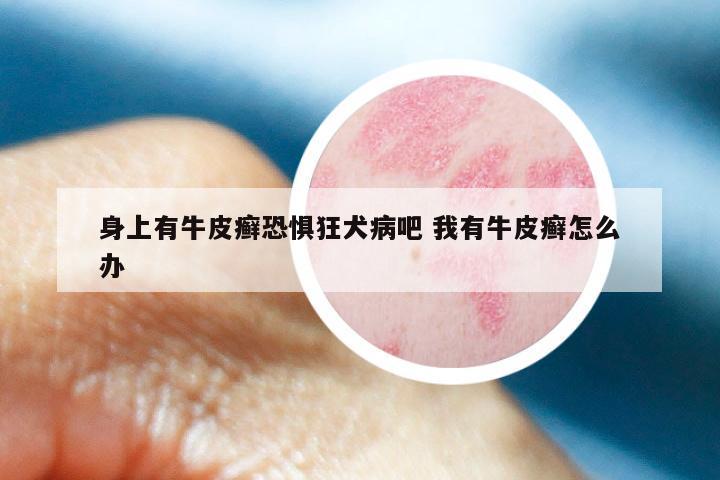 身上有牛皮癣恐惧狂犬病吧 我有牛皮癣怎么办