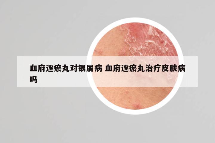 血府逐瘀丸对银屑病 血府逐瘀丸治疗皮肤病吗