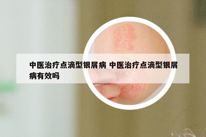 中医治疗点滴型银屑病 中医治疗点滴型银屑病有效吗