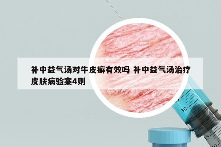 补中益气汤对牛皮癣有效吗 补中益气汤治疗皮肤病验案4则