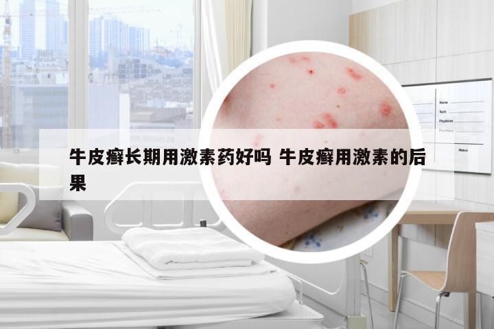 牛皮癣长期用激素药好吗 牛皮癣用激素的后果