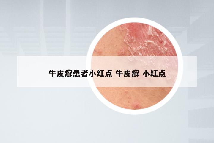 牛皮癣患者小红点 牛皮癣 小红点