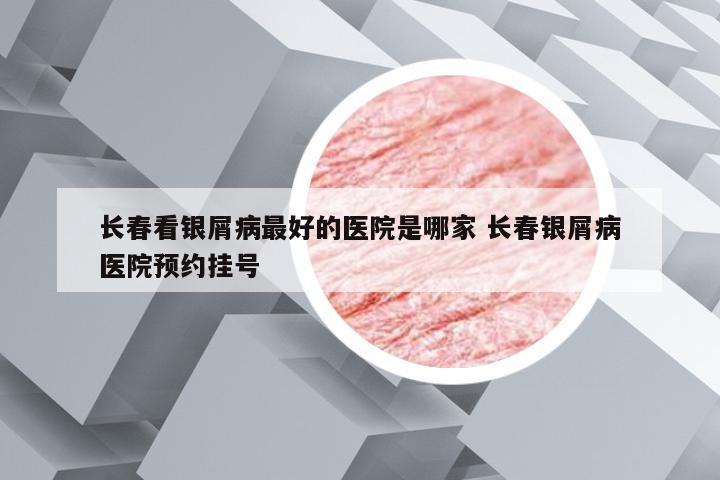 长春看银屑病最好的医院是哪家 长春银屑病医院预约挂号