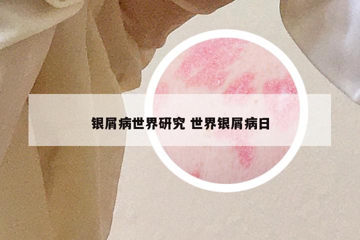 银屑病世界研究 世界银屑病日