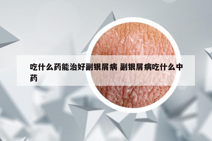 吃什么药能治好副银屑病 副银屑病吃什么中药