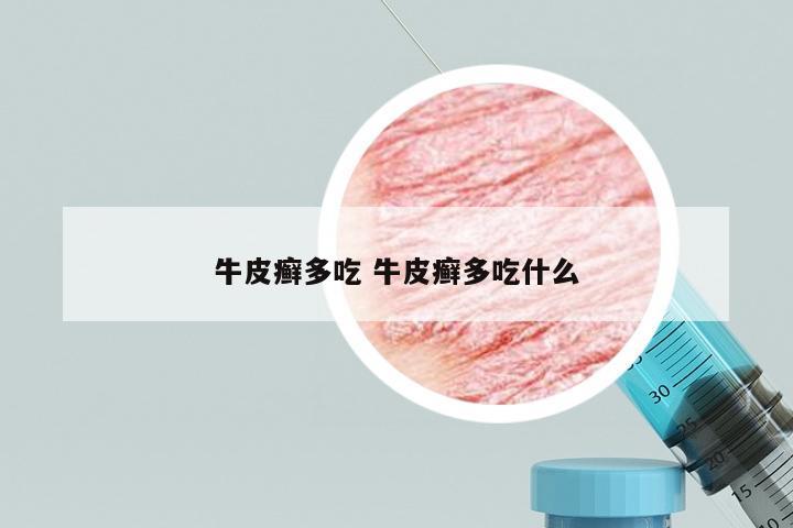 牛皮癣多吃 牛皮癣多吃什么
