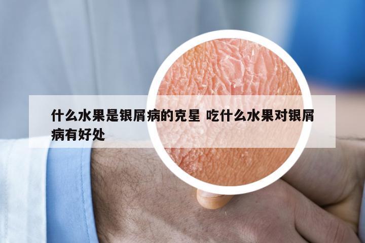 什么水果是银屑病的克星 吃什么水果对银屑病有好处