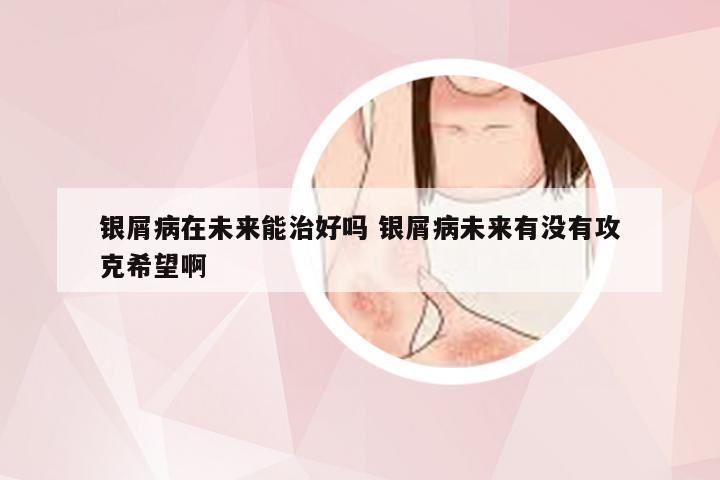 银屑病在未来能治好吗 银屑病未来有没有攻克希望啊