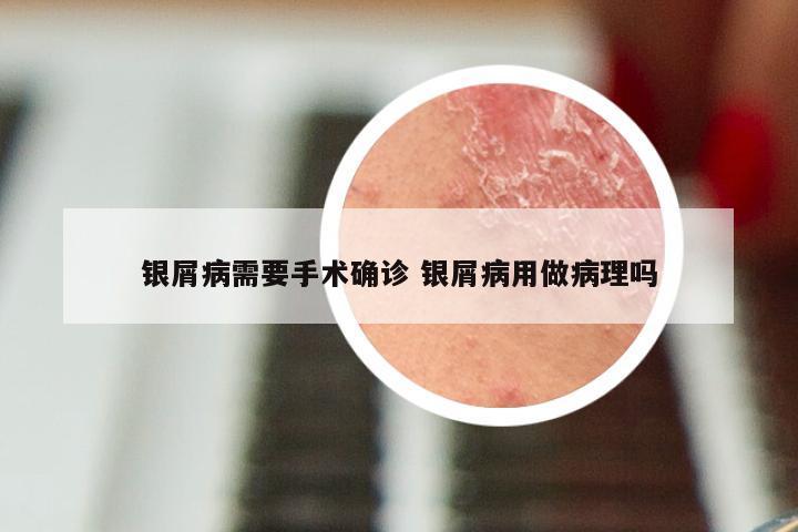 银屑病需要手术确诊 银屑病用做病理吗