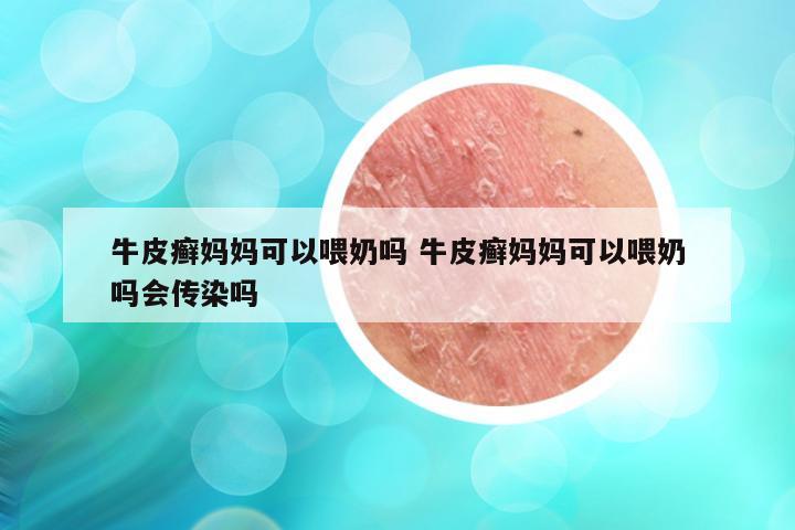 牛皮癣妈妈可以喂奶吗 牛皮癣妈妈可以喂奶吗会传染吗