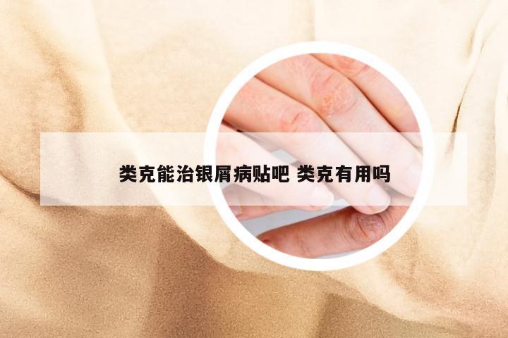 类克能治银屑病贴吧 类克有用吗