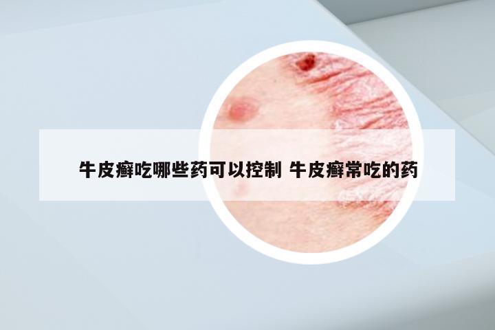 牛皮癣吃哪些药可以控制 牛皮癣常吃的药