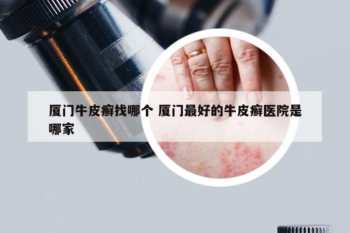 厦门牛皮癣找哪个 厦门最好的牛皮癣医院是哪家