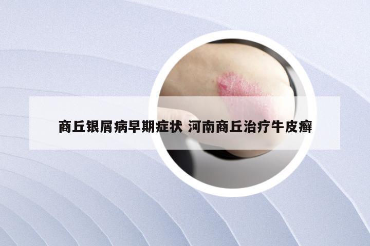 商丘银屑病早期症状 河南商丘治疗牛皮癣