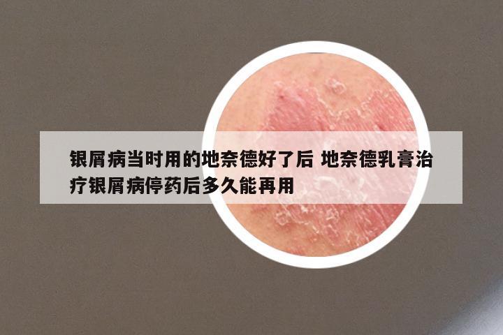 银屑病当时用的地奈德好了后 地奈德乳膏治疗银屑病停药后多久能再用