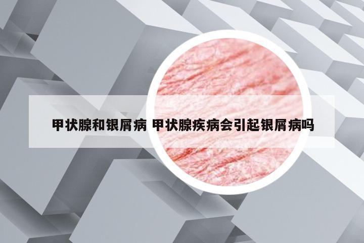 甲状腺和银屑病 甲状腺疾病会引起银屑病吗