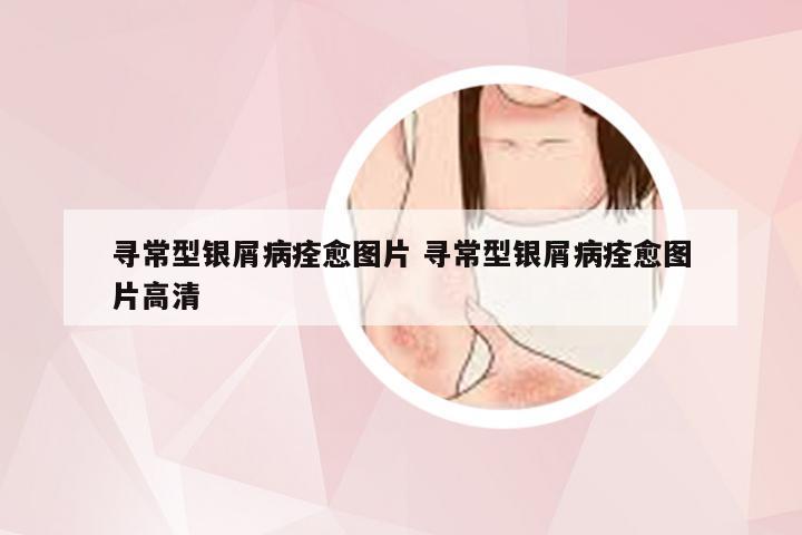 寻常型银屑病痊愈图片 寻常型银屑病痊愈图片高清