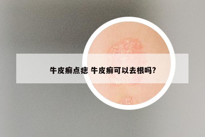 牛皮癣点痣 牛皮癣可以去根吗?