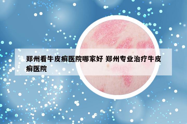 郑州看牛皮癣医院哪家好 郑州专业治疗牛皮癣医院