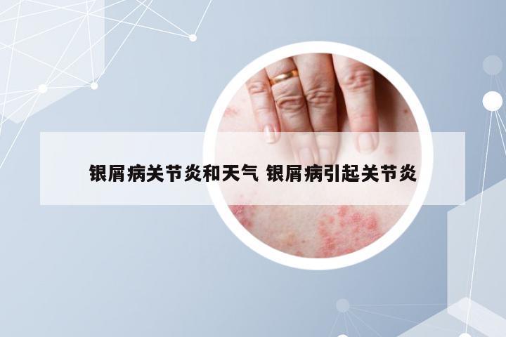 银屑病关节炎和天气 银屑病引起关节炎