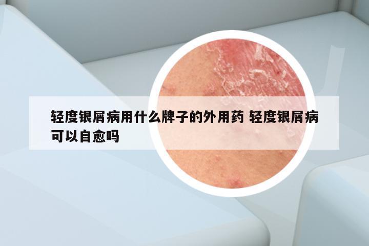 轻度银屑病用什么牌子的外用药 轻度银屑病可以自愈吗