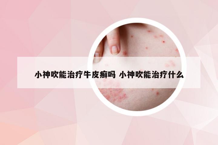 小神吹能治疗牛皮癣吗 小神吹能治疗什么